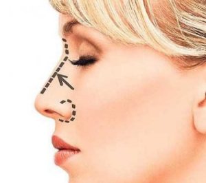 جراحی بینی استخوانی چیست؟