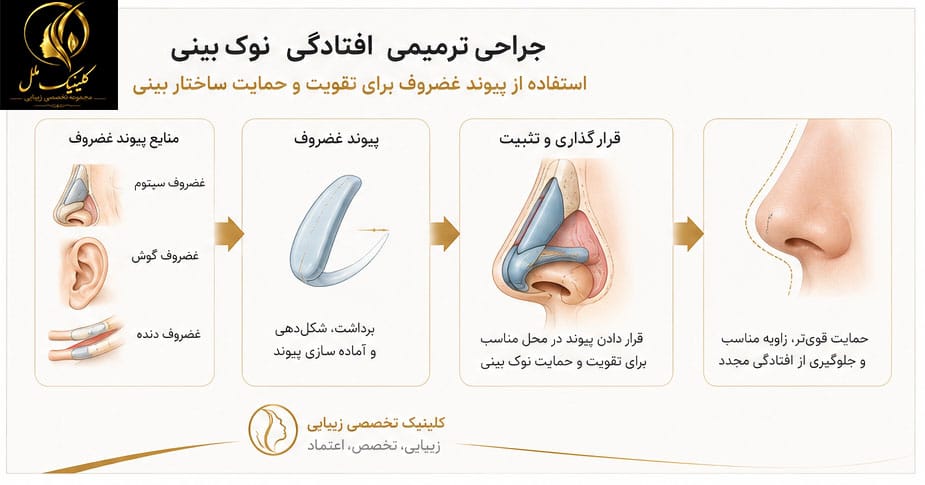 005 پیوند غضروف برای تقویت و حمایت ساختار بینی