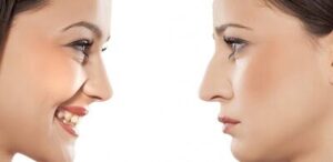 تفاوت های انواع جراحی بینی