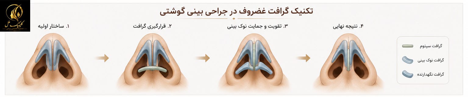 نمایش گرافت غضروف در جراحی بینی گوشتی برای تقویت نوک بینی