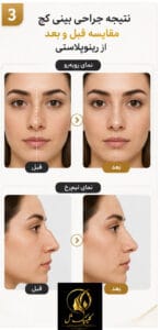 بینی کج