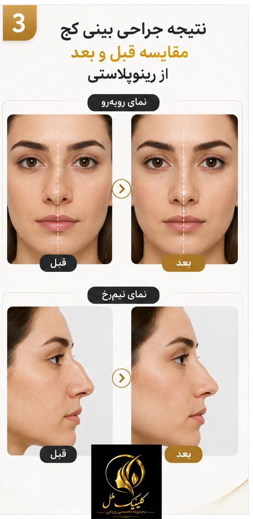 بینی کج چیست؟ علتها، علائم و روشهای درمان بینی کج