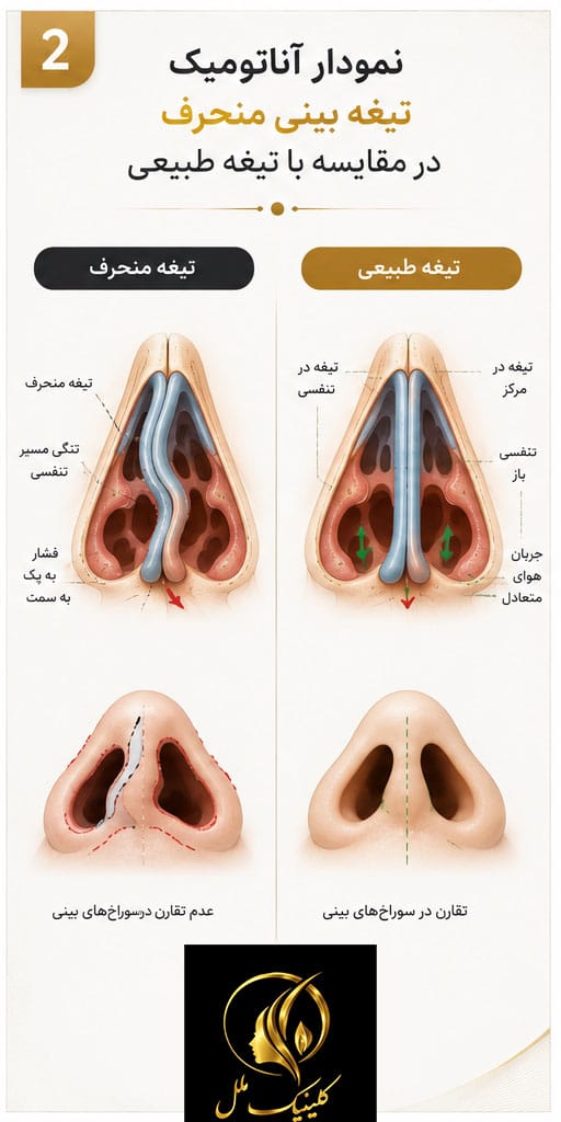 نمودار آناتومیک تیغه بینی منحرف در مقایسه با تیغه طبیعی