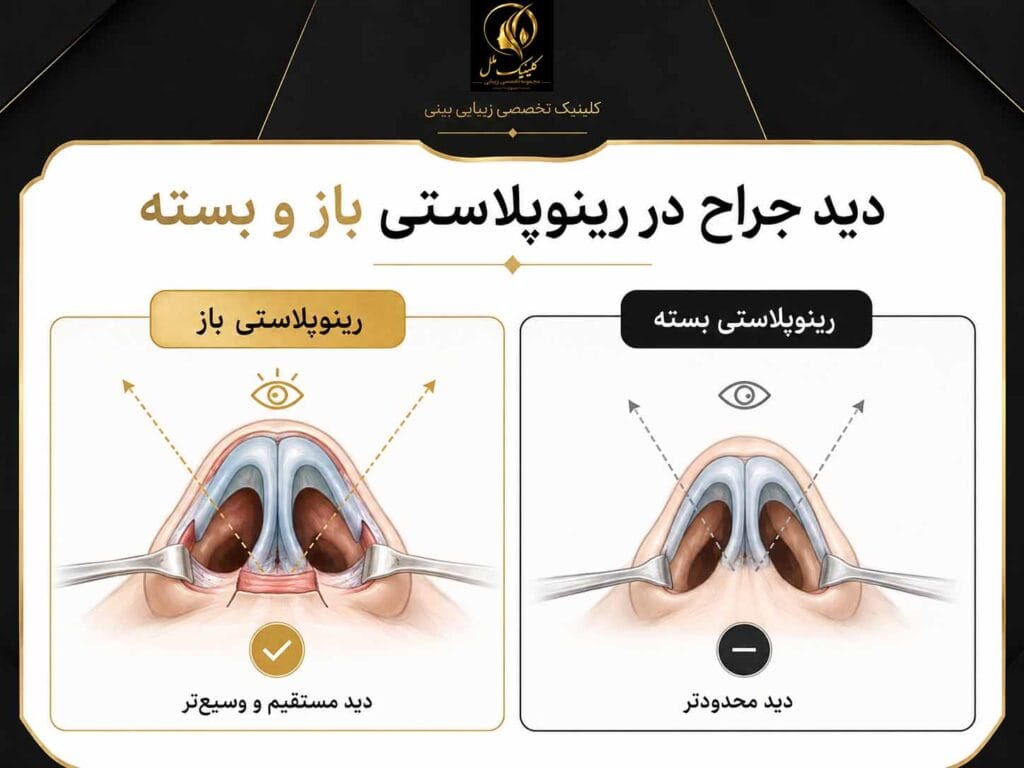 تفاوت جراحی بینی باز و بسته