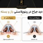تفاوت جراحی بینی باز و بسته