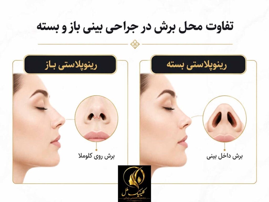تفاوت محل برش در جراحی بینی باز و بسته