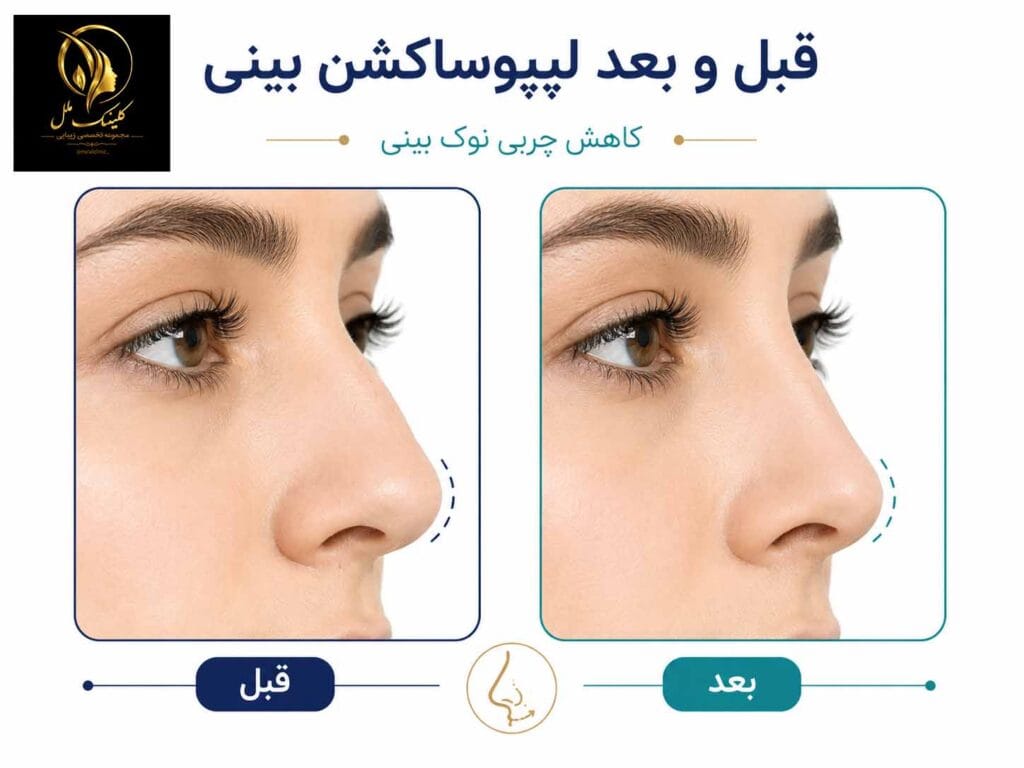 قبل و بعد لیپوساکشن بینی