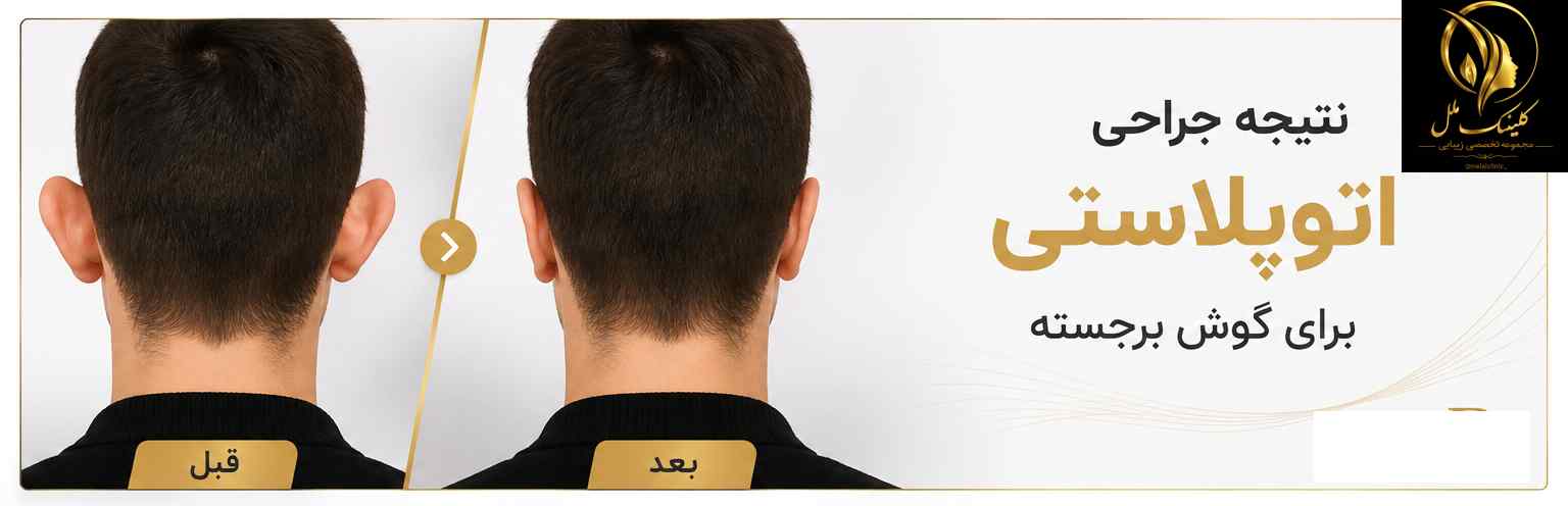 نتیجه جراحی اتوپلاستی برای گوش برجسته