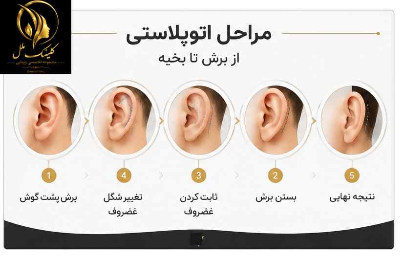 مراحل اتوپلاستی از برش تا بخیه