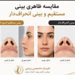 بینی انحراف دار