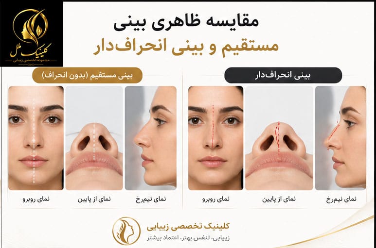 a2 بینی انحراف دار