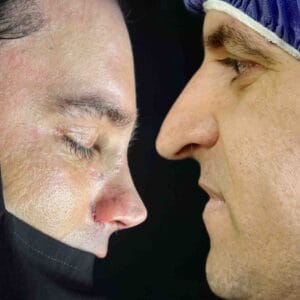 بعد از جراحی بینی طبیعی &ndash; نمای سه&zwnj;رخ، نتیجه نهایی&zwnj;تر رینوپلاستی با تناسب پل و تیپ بینی
