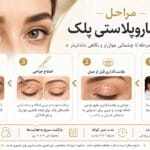 بلفاروپلاستی