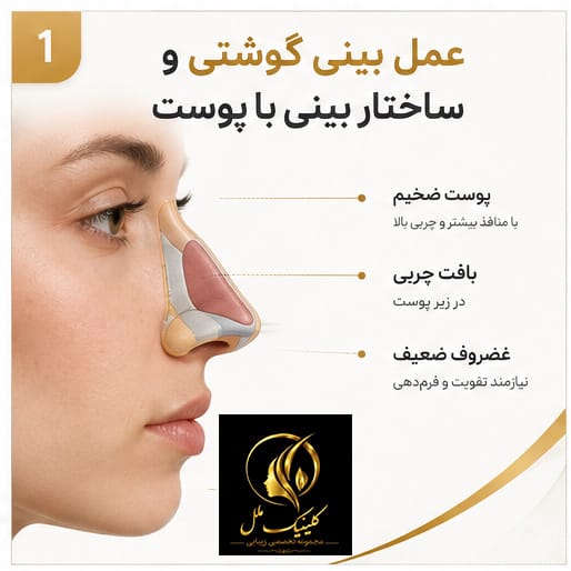 عمل بینی گوشتی و ساختار بینی با پوست