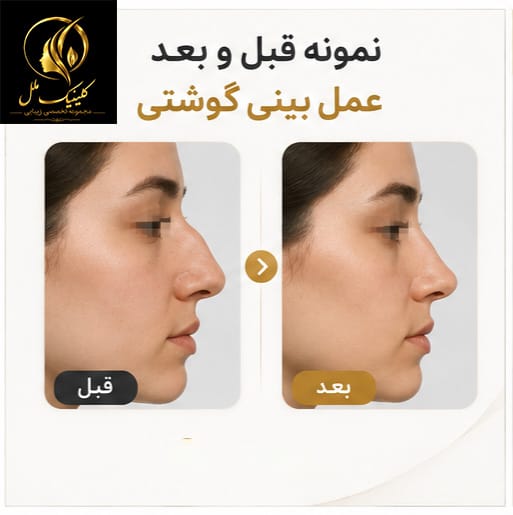 نمونه قبل و بعد عمل بینی گوشتی