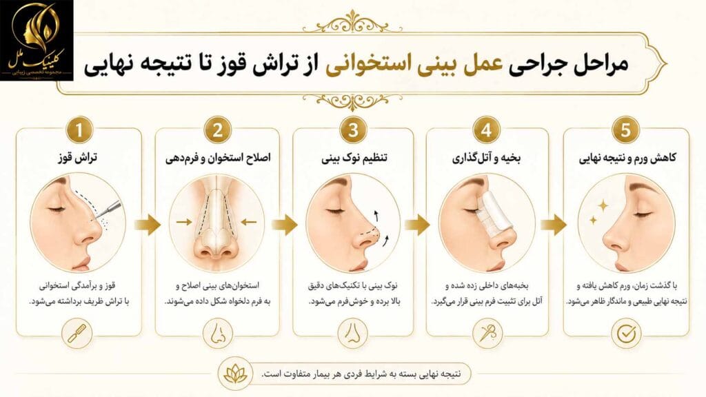 bone-nose1 مراحل جراحی عمل بینی استخوانی از تراش قوز تا نتیجه نهایی