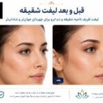 لیفت شقیقه