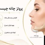 پروتز چانه