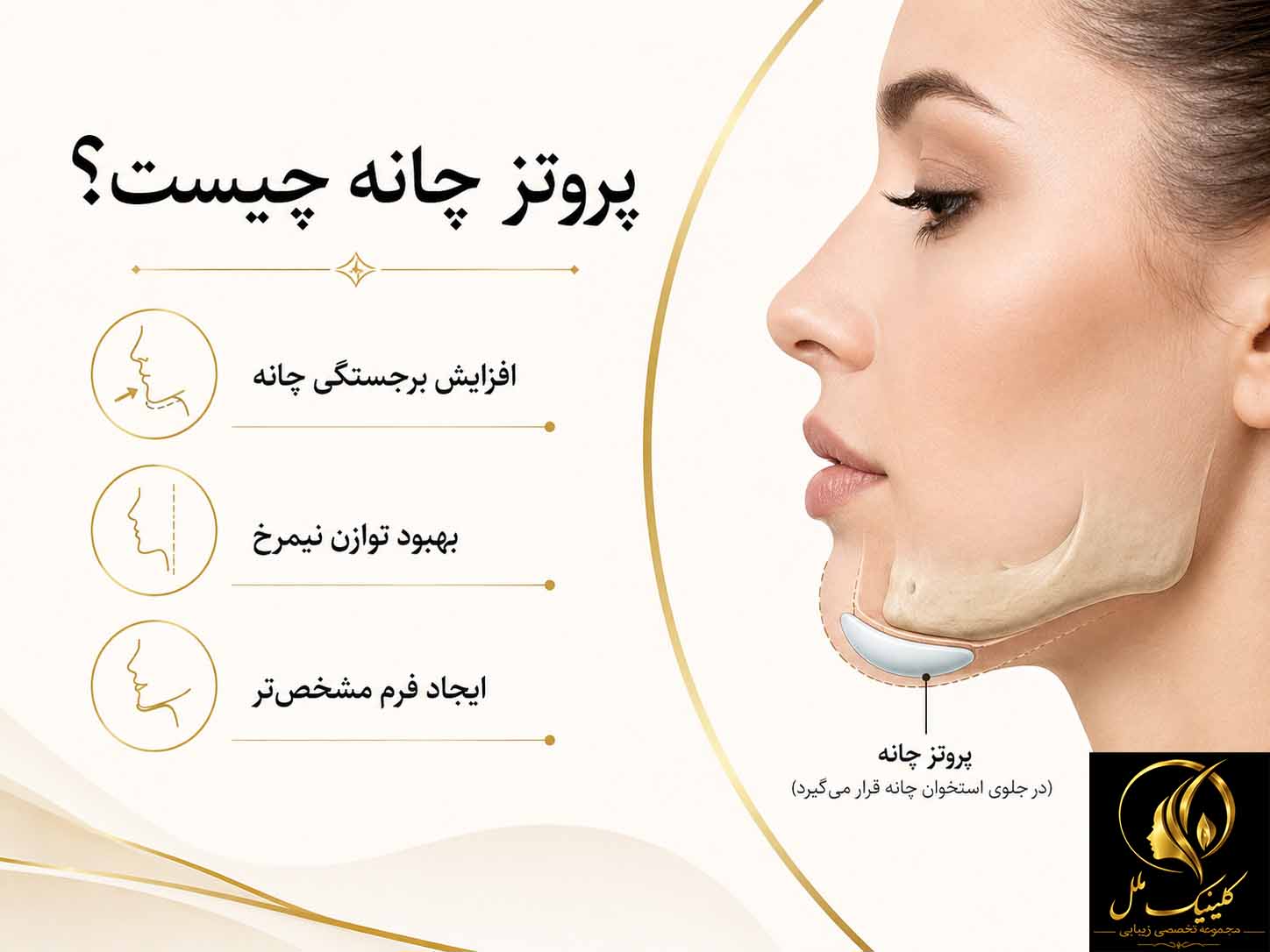 chin-implant پروتز چانه