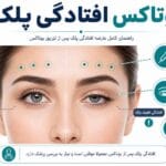 بوتاکس افتادگی پلک