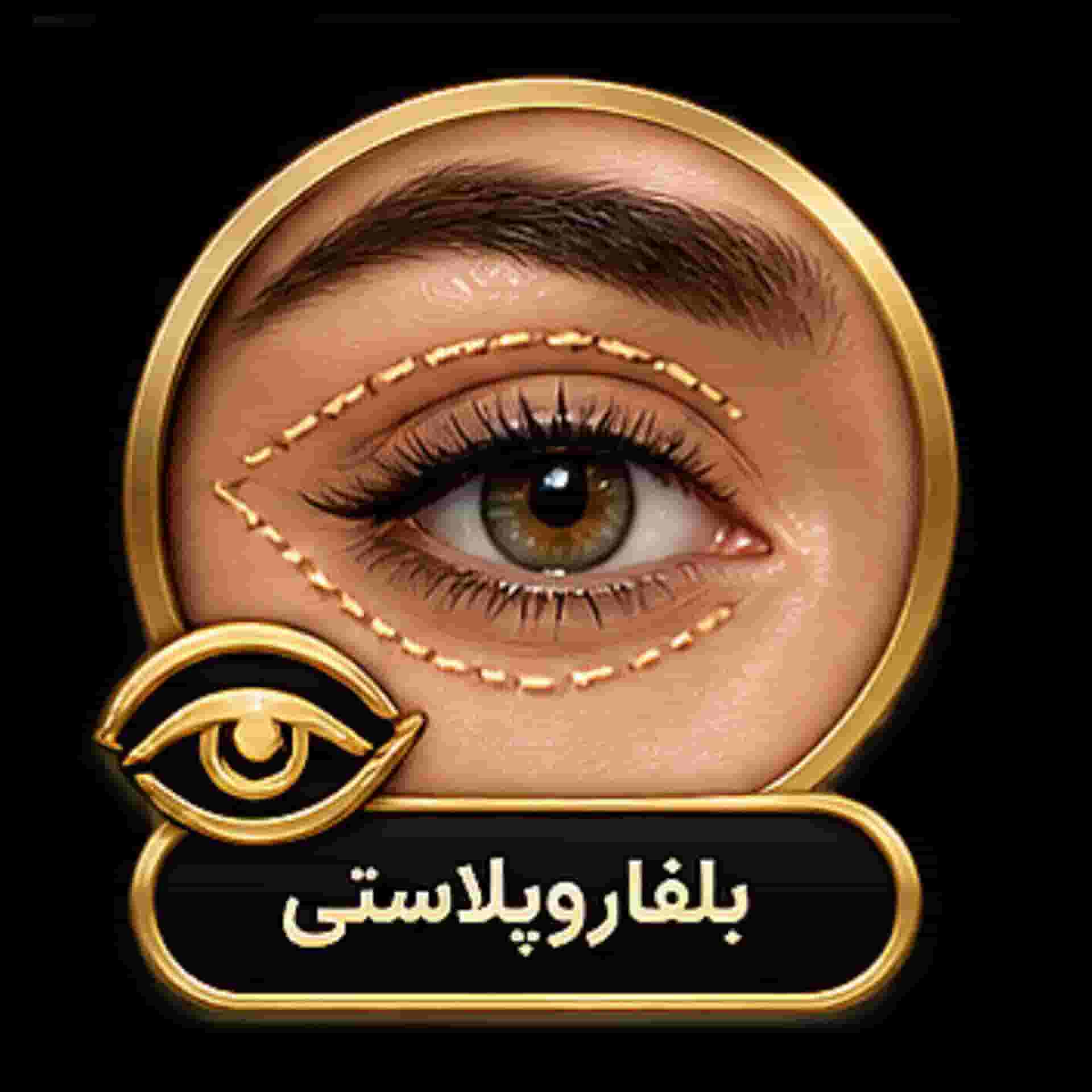 blepharoplasty