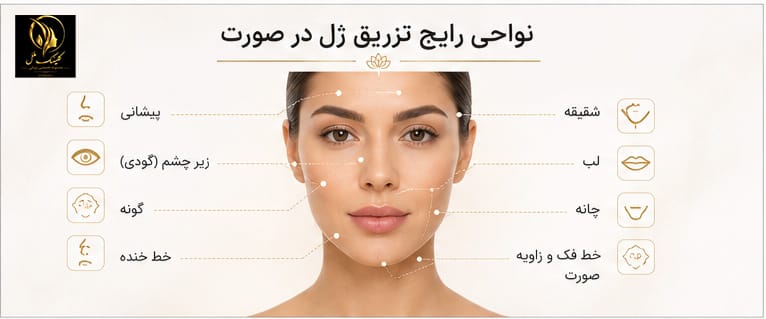 injection-areas-face نواحی رایج تزریق ژل روی صورت