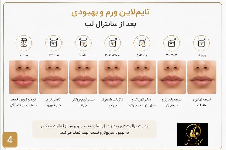 تایم&zwnj;لاین ورم و بهبودی بعد از سانترال لب