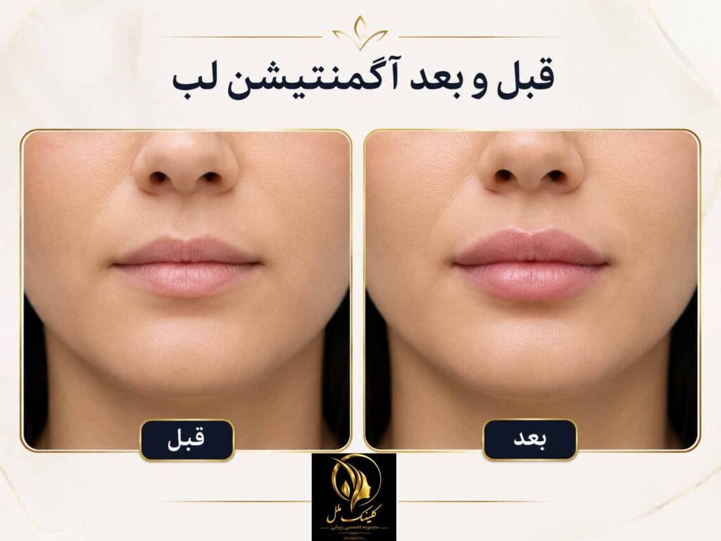 lip-injection001 آگمنتیشن لب