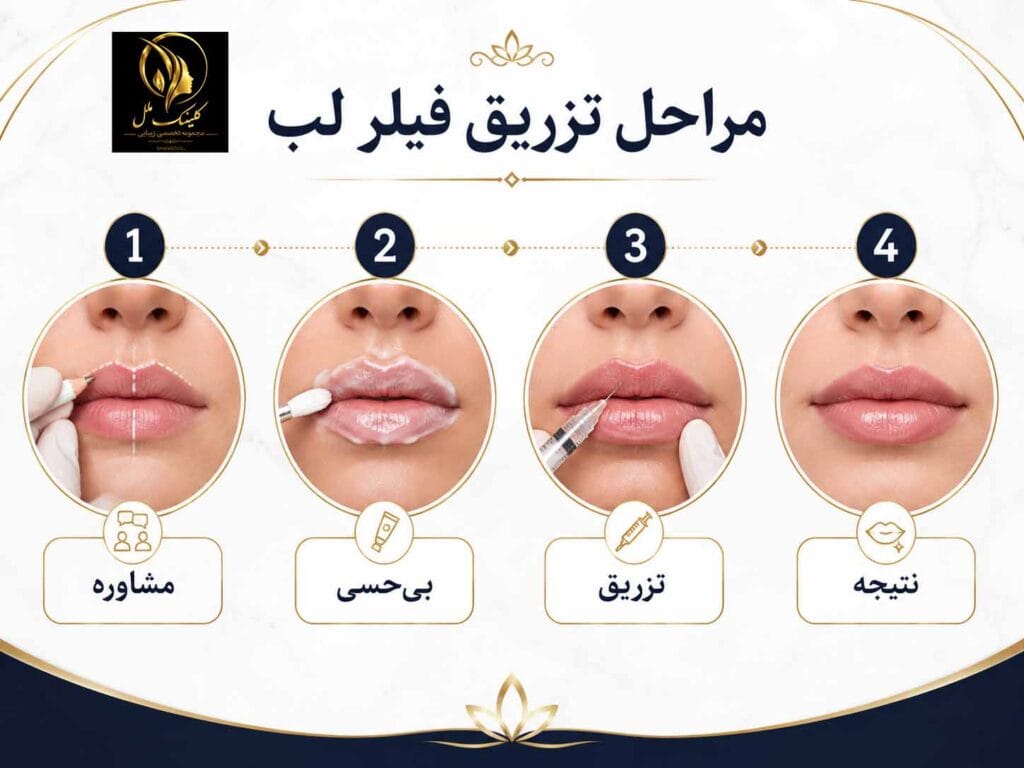 lip-injection003 آگمنتیشن لب چیست؟