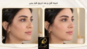 فیلر بینی