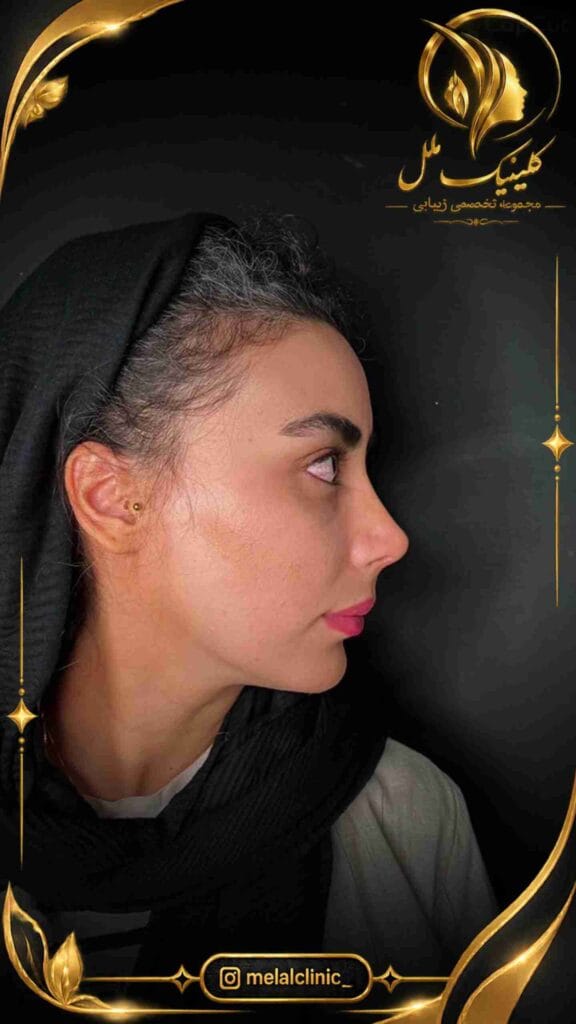نتیجه جراحی بینی ۶ ماه پس از عمل – نمای نیمرخ، پل بینی صاف و فرم طبیعی نوک بینی