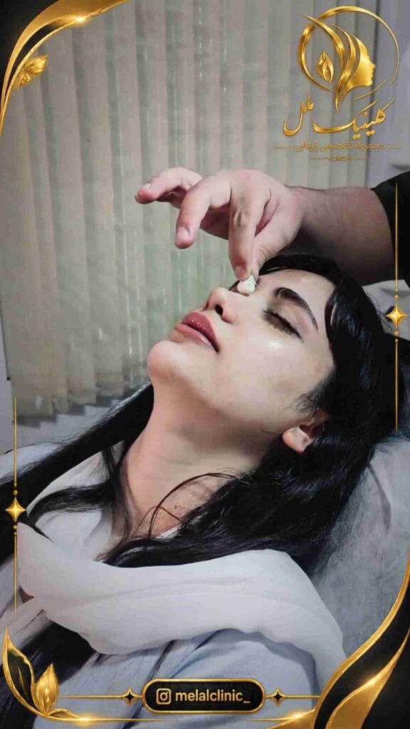 نتیجه عمل بینی طبیعی ۹ ماه پس از جراحی – نمای سهرخ، حفظ فرم متناسب پل و تیپ بینی