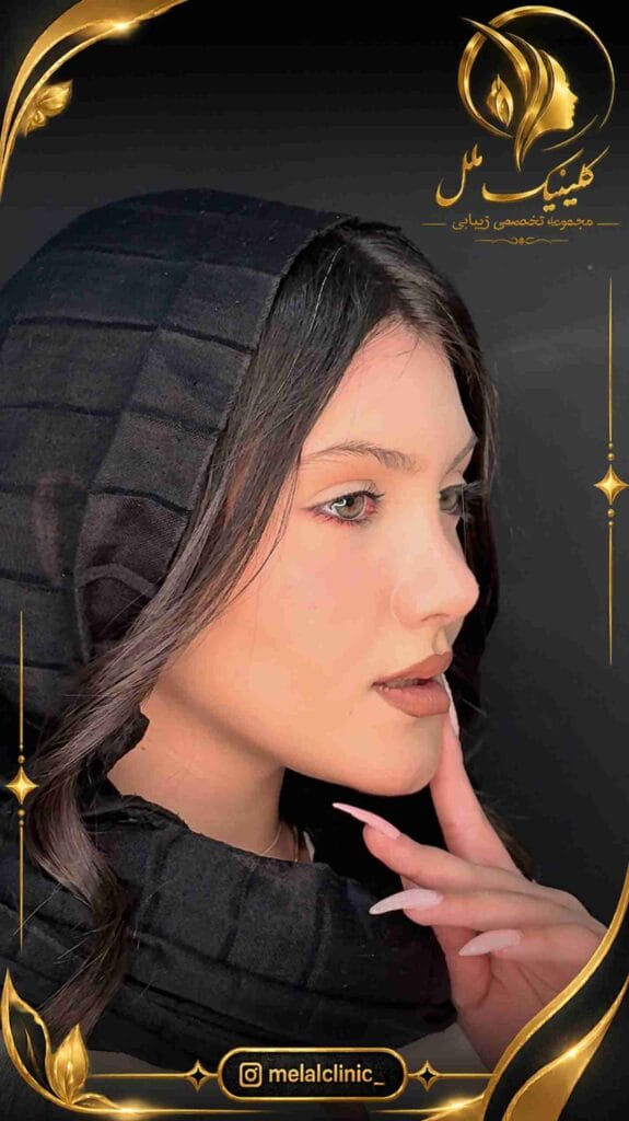نتیجه جراحی بینی یک سال پس از عمل – نمای سهرخ، فرم متعادل تیپ و کلوملای بینی