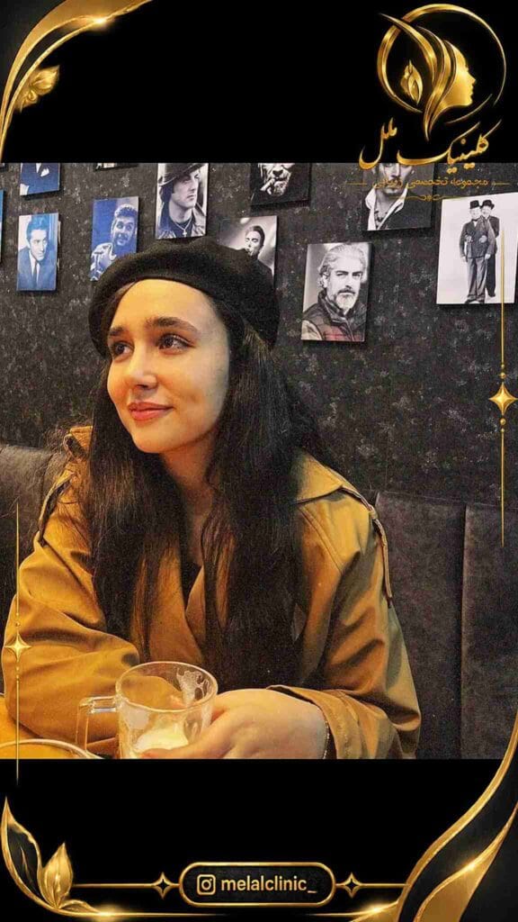 بعد از رینوپلاستی – نمای روبهرو، تقارن نسبی سوراخهای بینی و فرم طبیعی نوک