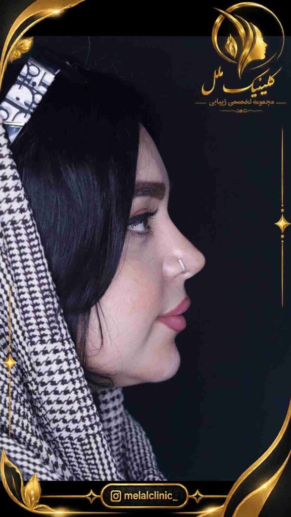 نتیجه عمل زیبایی بینی ۶ ماه پس از جراحی – نمای نیمرخ، اصلاح قوز پل بینی