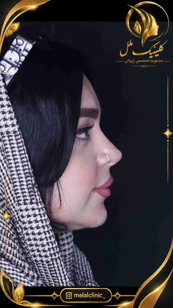 نتیجه عمل زیبایی بینی ۶ ماه پس از جراحی &ndash; نمای نیم&zwnj;رخ، اصلاح قوز پل بینی