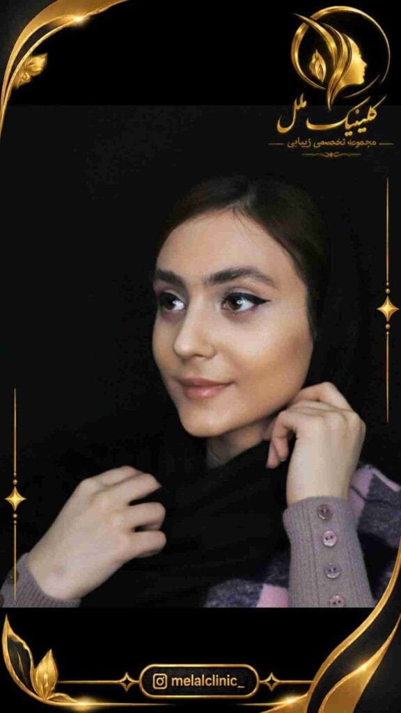 بعد از جراحی بینی – نمای سهرخ، تناسب پروجکشن بینی با چانه و لبها