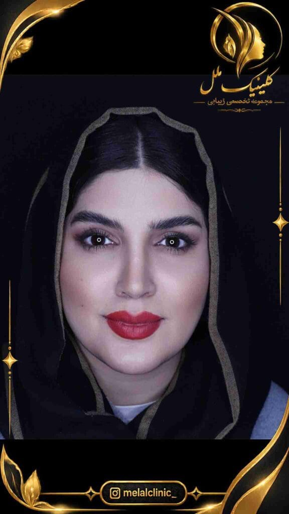 نتیجه رینوپلاستی طبیعی بیش از ۶ ماه پس از عمل – نمای روبهرو، باریکتر شدن ظاهر پل بینی