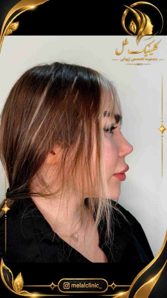 نتیجه جراحی بینی ۸ ماه پس از عمل – نمای سهرخ، فرم هماهنگ نوک و پل بینی