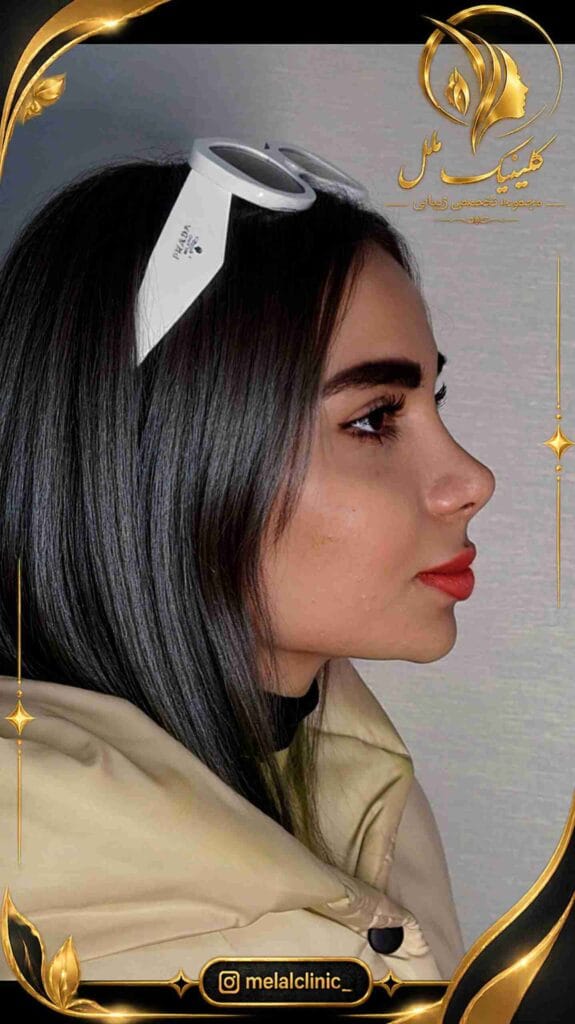 بعد از رینوپلاستی – نمای روبهرو، بهبود نمای پرههای بینی و تیپ بینی