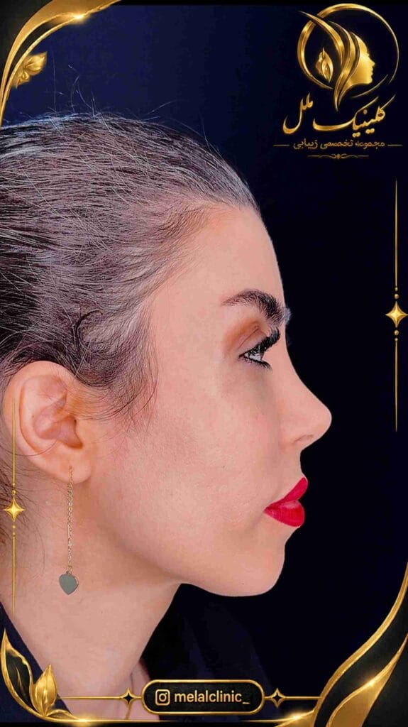 نتیجه عمل بینی بیش از ۶ ماه پس از جراحی – نمای نیمرخ، زاویه نازولبیال متناسب