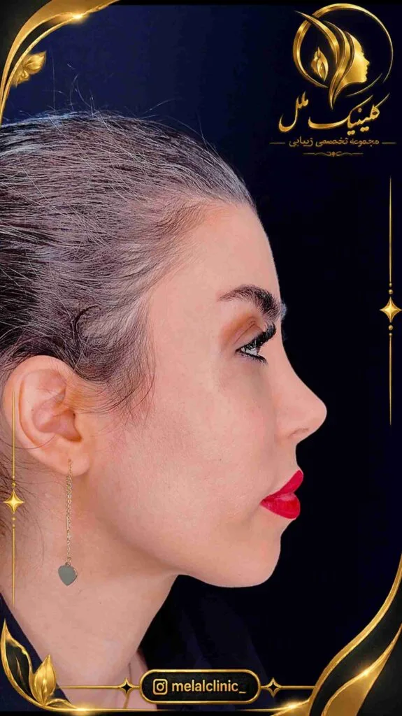 نتیجه عمل بینی بیش از ۶ ماه پس از جراحی &ndash; نمای نیم&zwnj;رخ، زاویه نازولبیال متناسب