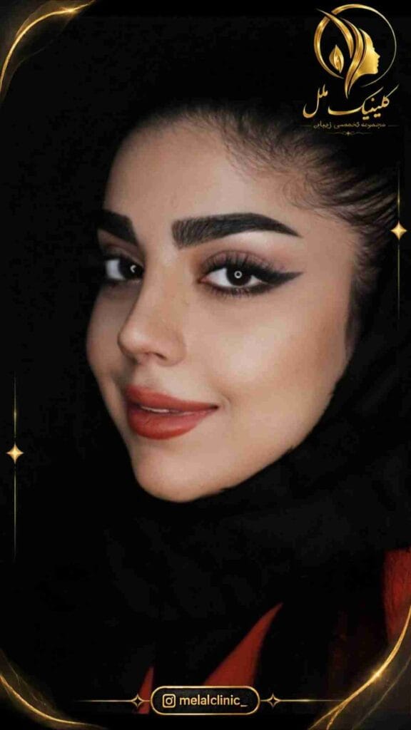 بعد از جراحی زیبایی بینی – نمای سهرخ راست، فرم طبیعی کلوملا و نوک بینی