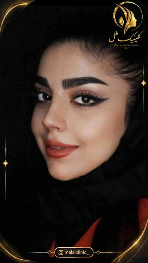 بعد از جراحی زیبایی بینی &ndash; نمای سه&zwnj;رخ راست، فرم طبیعی کلوملا و نوک بینی