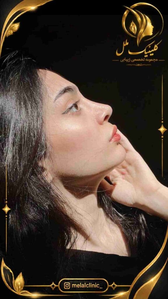 بعد از عمل بینی – نمای نیمرخ چپ، اصلاح انحنای پل و فرم متعادل بینی