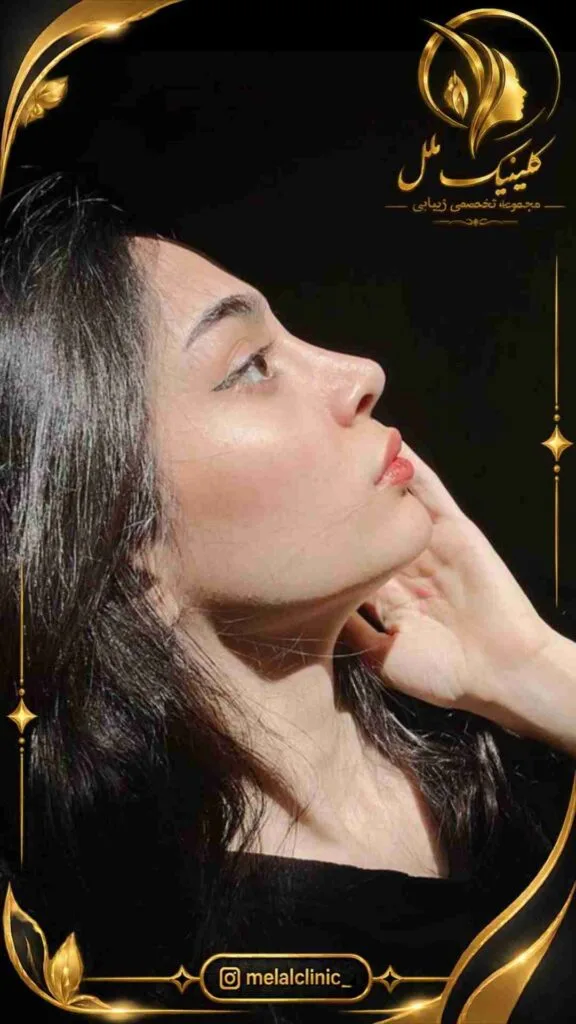 بعد از عمل بینی &ndash; نمای نیم&zwnj;رخ چپ، اصلاح انحنای پل و فرم متعادل بینی