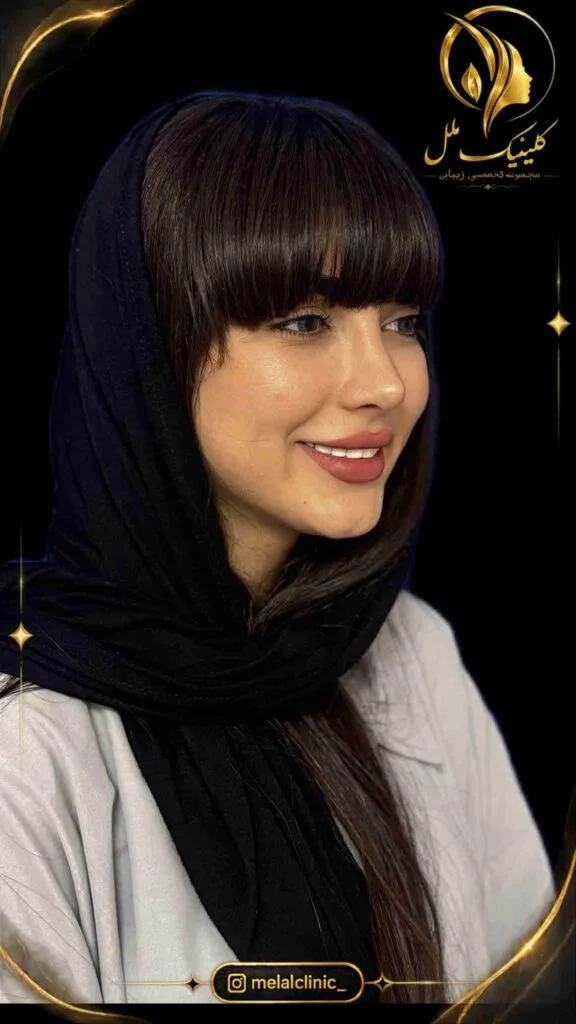 نتیجه عمل بینی یک سال پس از جراحی &ndash; نمای نیم&zwnj;رخ، پشت بینی صاف و تیپ طبیعی