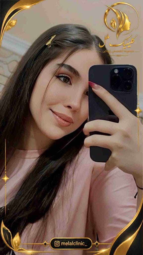 نتیجه رینوپلاستی بیش از ۶ ماه پس از عمل – نمای روبهرو، کاهش نمای پهن نوک بینی