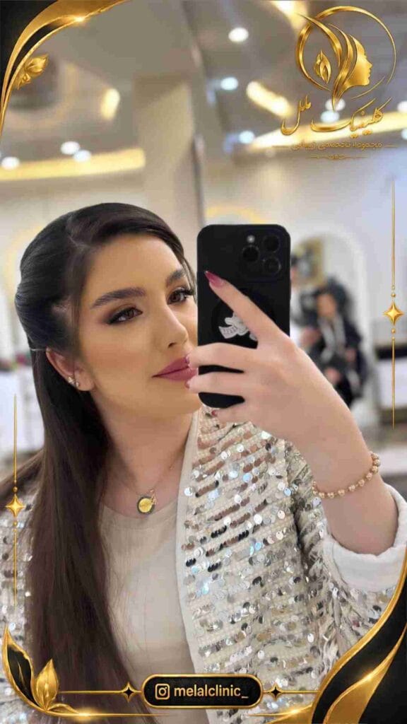 نتیجه جراحی بینی ۷ ماه پس از عمل – نمای سهرخ چپ، هماهنگی تیپ بینی با نمای صورت