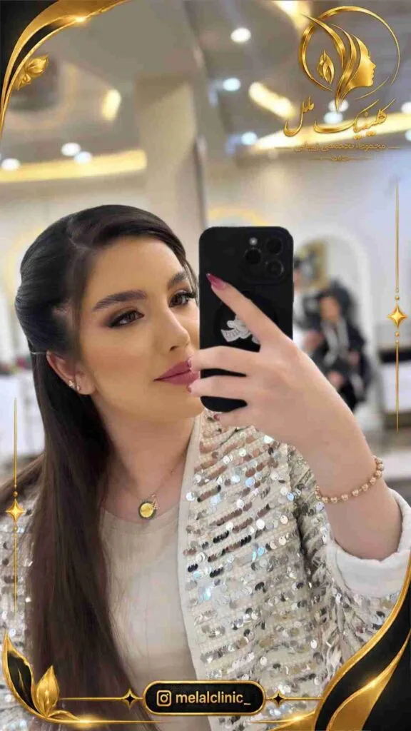 نتیجه جراحی بینی ۷ ماه پس از عمل &ndash; نمای سه&zwnj;رخ چپ، هماهنگی تیپ بینی با نمای صورت
